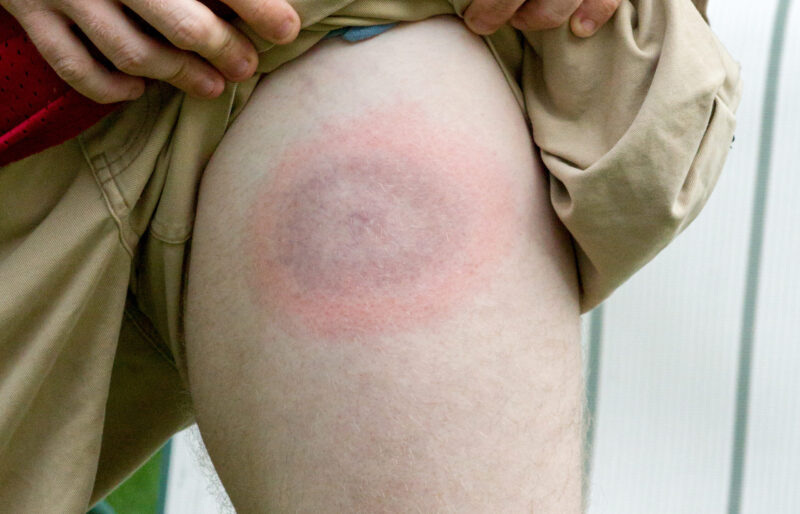 Lyme disease bullseye on young mans leg