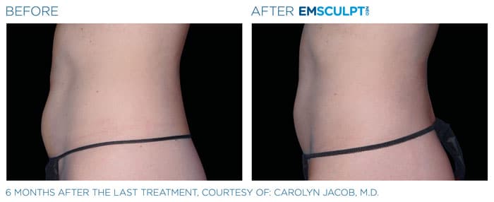How Does EMSCULPT NEO Build Muscle?