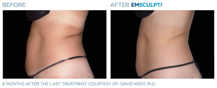 How Does EMSCULPT NEO Reduce Fat?