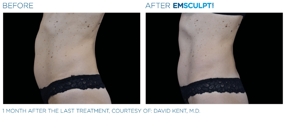 Benefits of EMSCULPT NEO